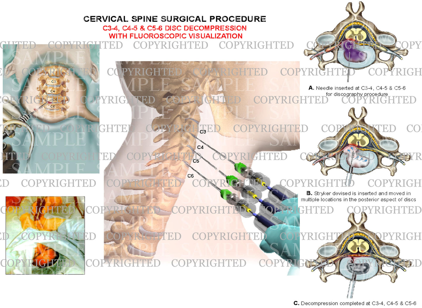 3 level - C3-4, C4-5 and C5-6 cervical spien decompression surgery with fluoroscopy