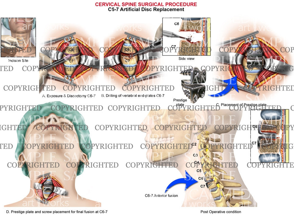 C6-7 artificial disc replacement - 1 level