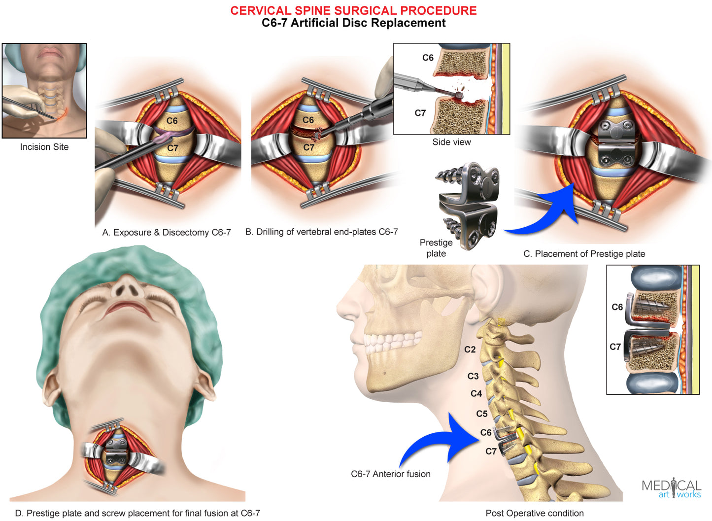 C6-7 artificial disc replacement - 1 level