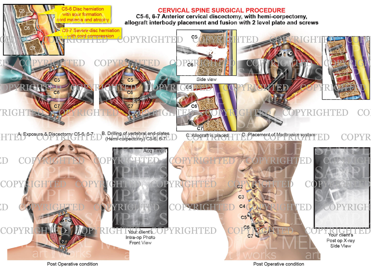 C4-5 and C5-6 herniations and X-rays -  ACDF