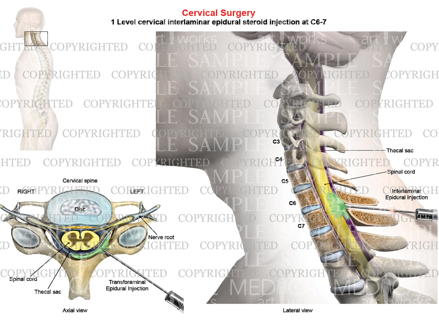 C6-7 Cervical Interlaminar Epidural Steroid Injection - Male