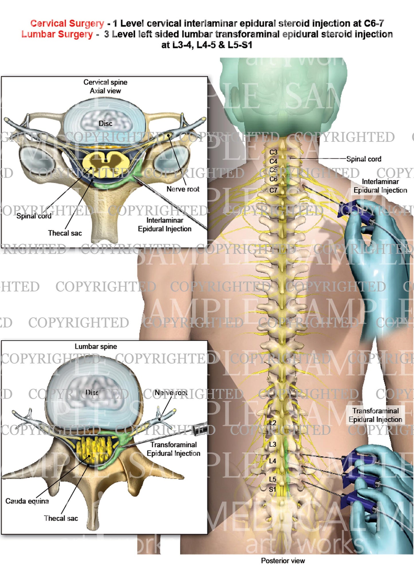 Cervical interlaminar epidural steroid injection