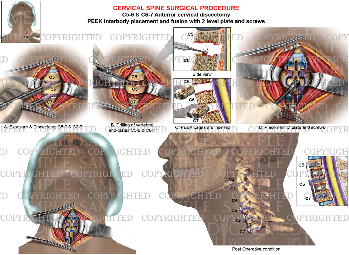 C5-6 - C6-7 cervical discectomy - fusion - PEEK - plate & screws