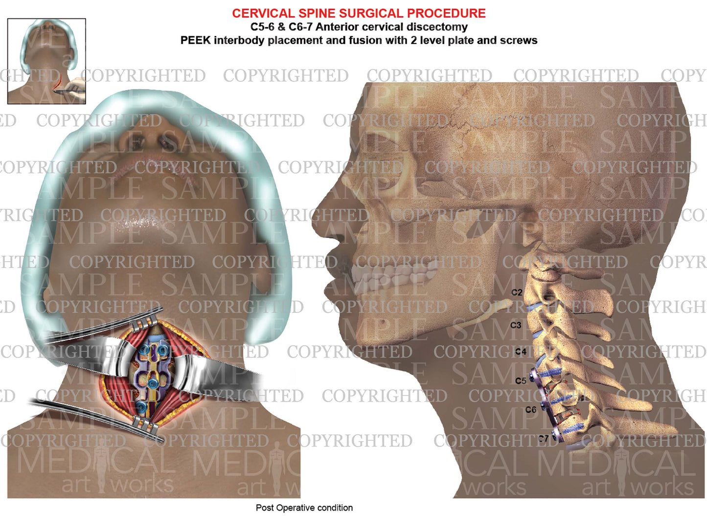 C5-6 - C6-7 Post operative condition cervical discectomy and fusion - PEEK - plate & screws