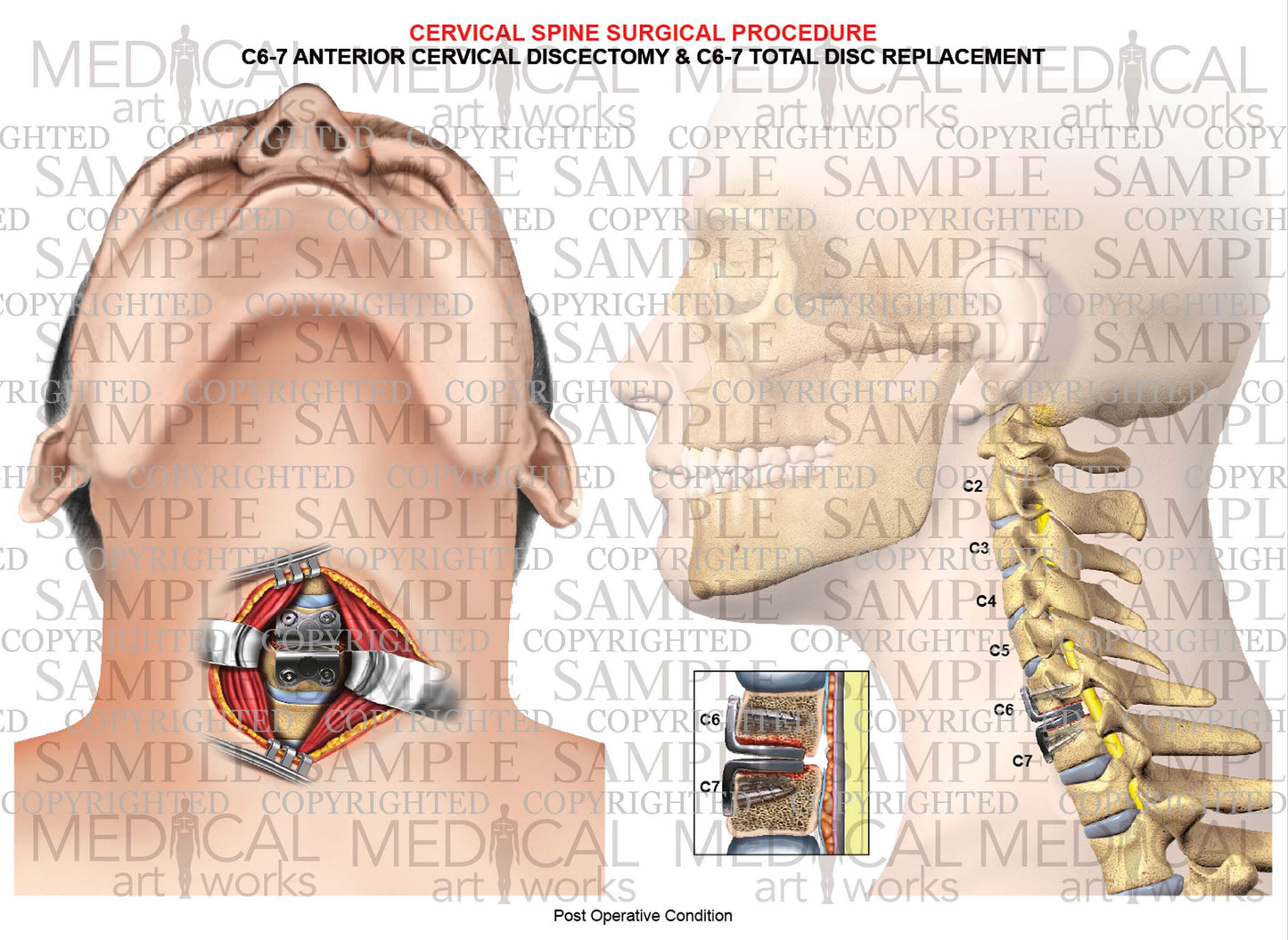 1 Level - C6-C7 Anterior cervical discectomy and fusion