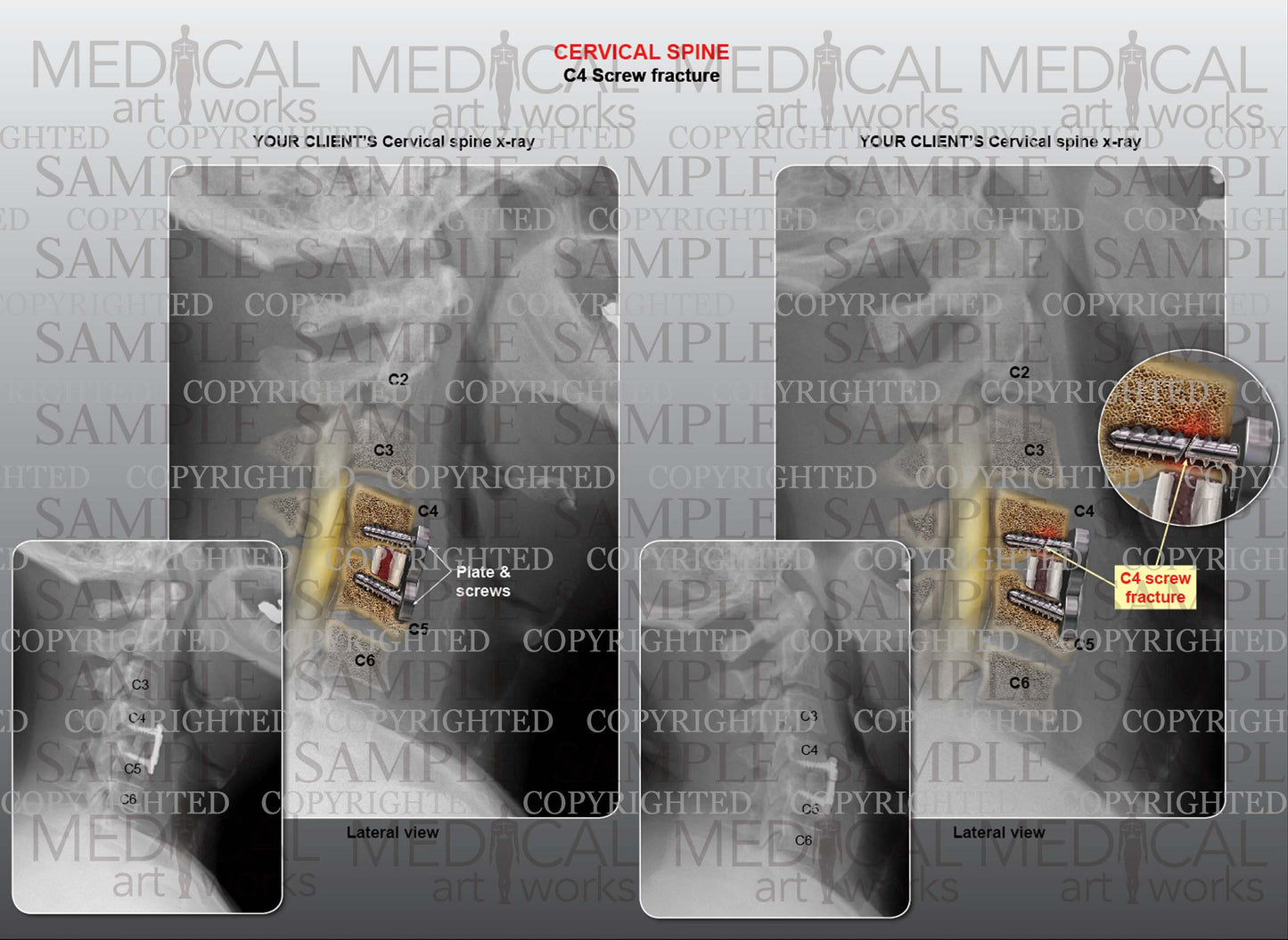 1 level - C4 screw fracture and fusion