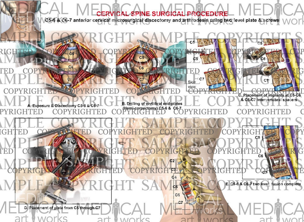 C5-6 & C6-7 anterior cervical microsurgical discectomy and arthrodesis