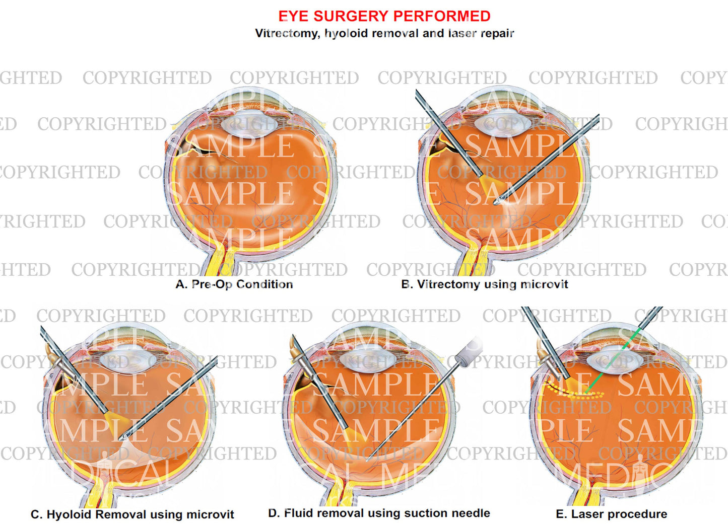 Eye surgery - Vitrectomy, hyoloid removal and laser repair