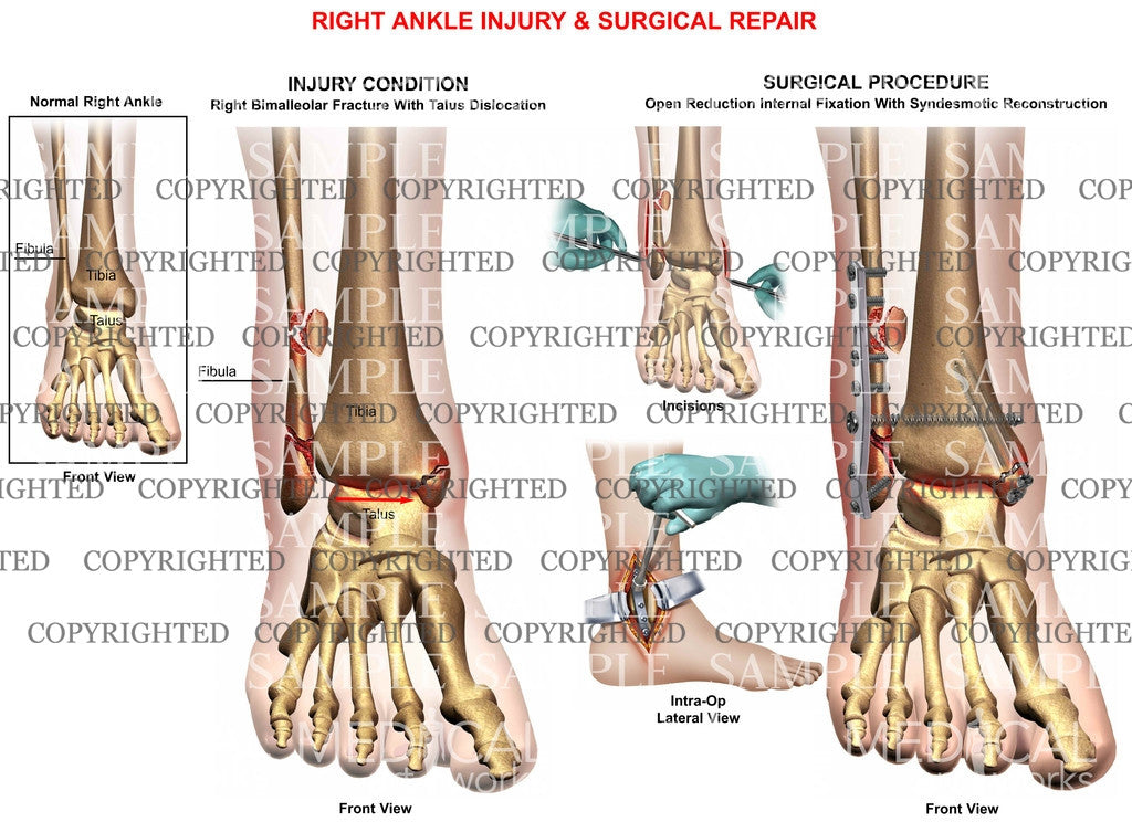 Right Tib-Fib, Talus dislocation & ORIF