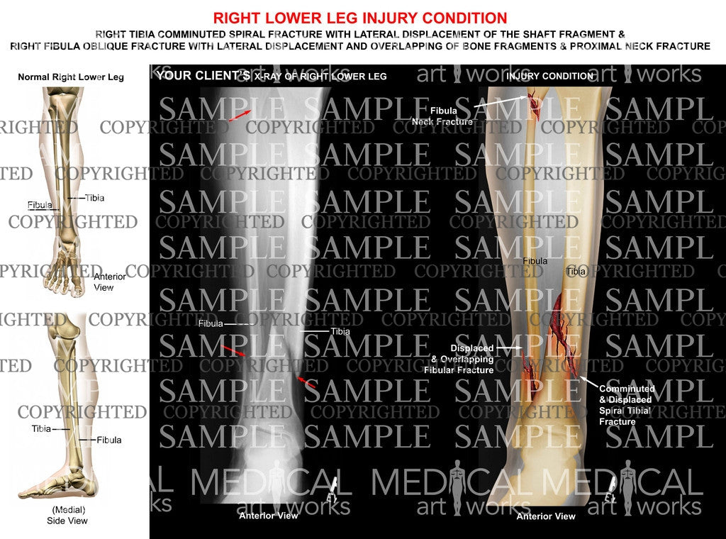 Right Tib-Fib spiral shaft fractures