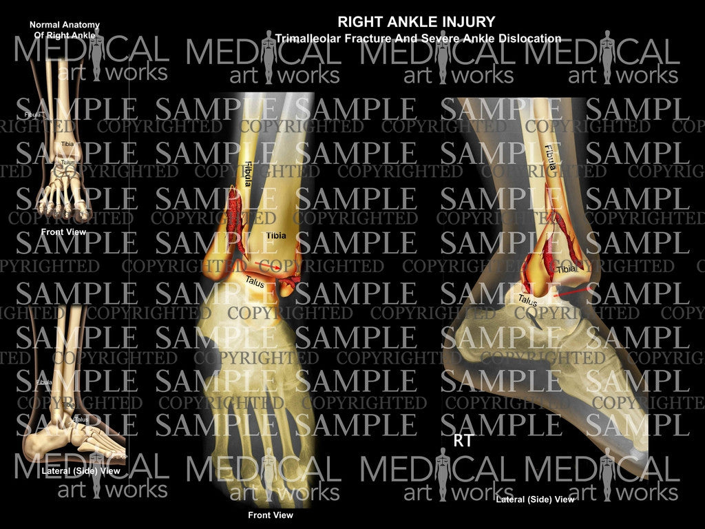 Right Trimalleolar severe dislocation