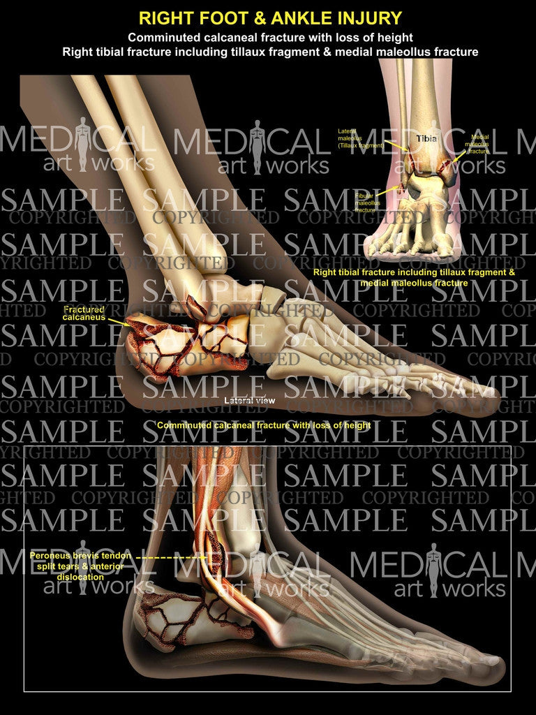 Right comminuted calcaneal fracture