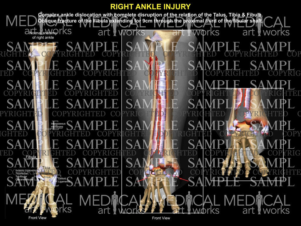 Right complex ankle ligament disruption