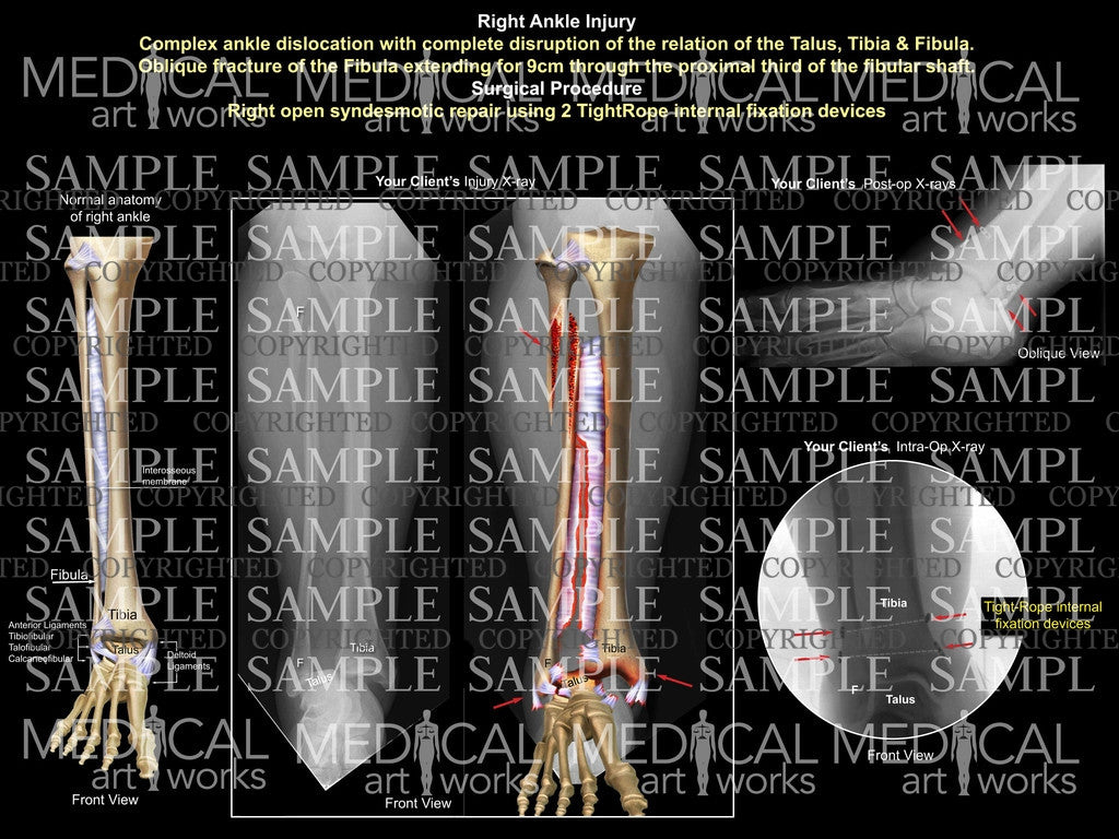 Right complex ligament disruption2