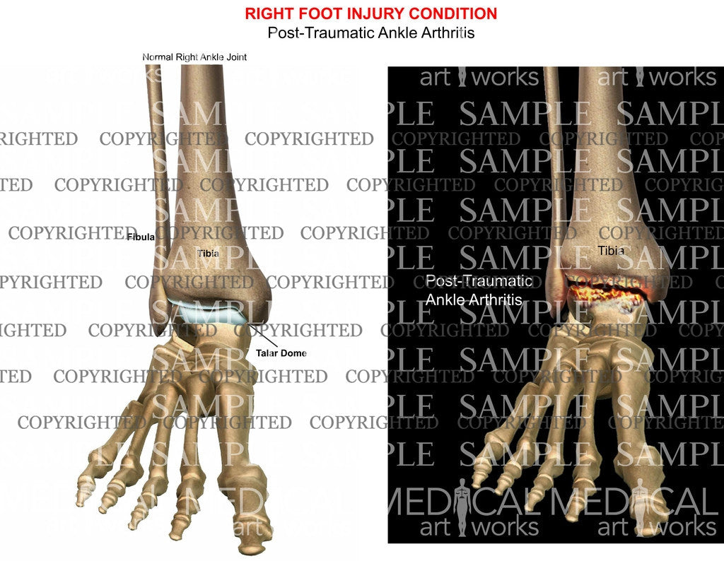 Post-traumatic ankle arthritis