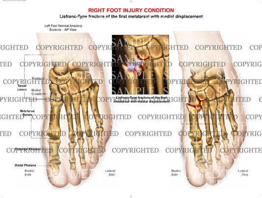 Injury to left midfoot with fracture and displacement