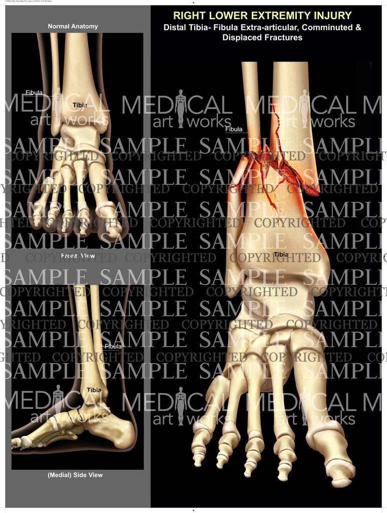 Right tibia and fibula comminuted / displaced fractures