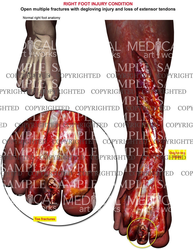 Right foot degloving injury condition