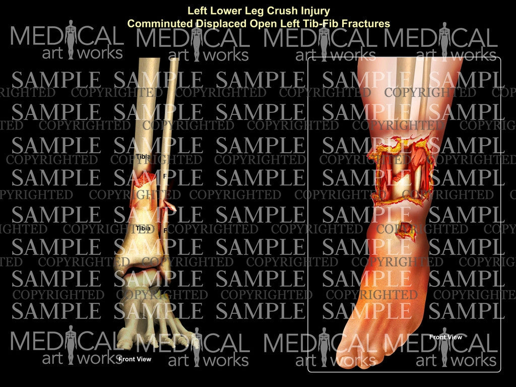 Left Lower Leg Crush Injury