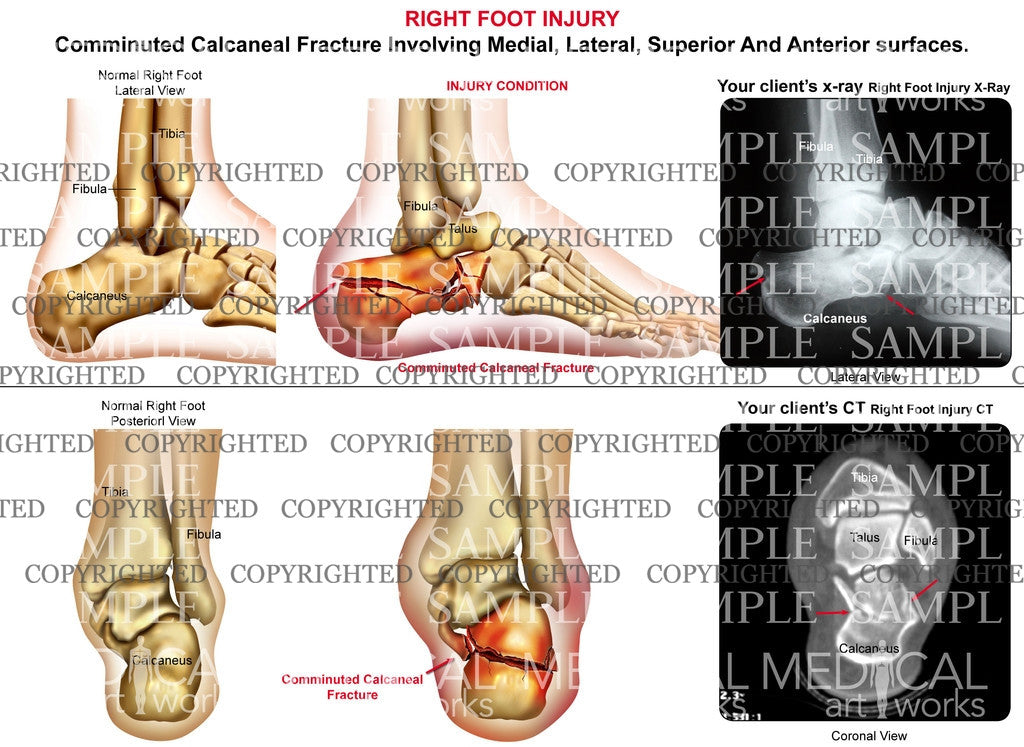 Right comminuted calcaneal fracture