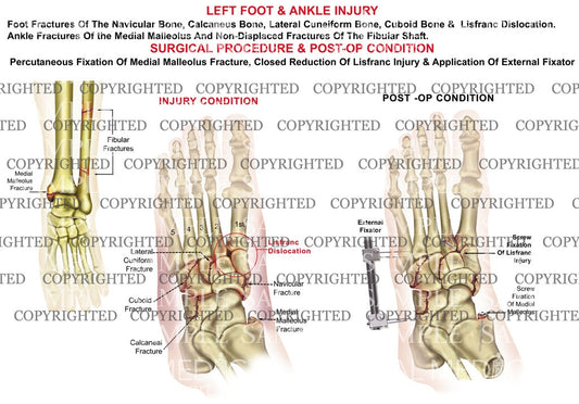 Left midfoot lisfranc dislocation & closed reduction, external fixation