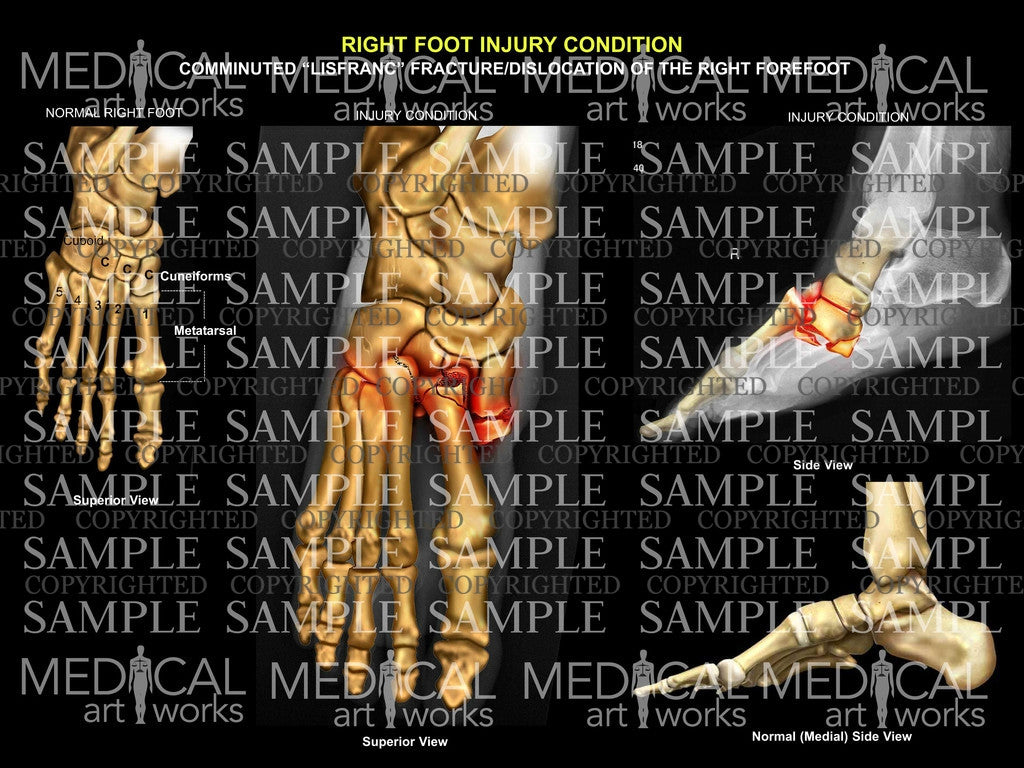 Right Foot Lisfranc fracture dislocation