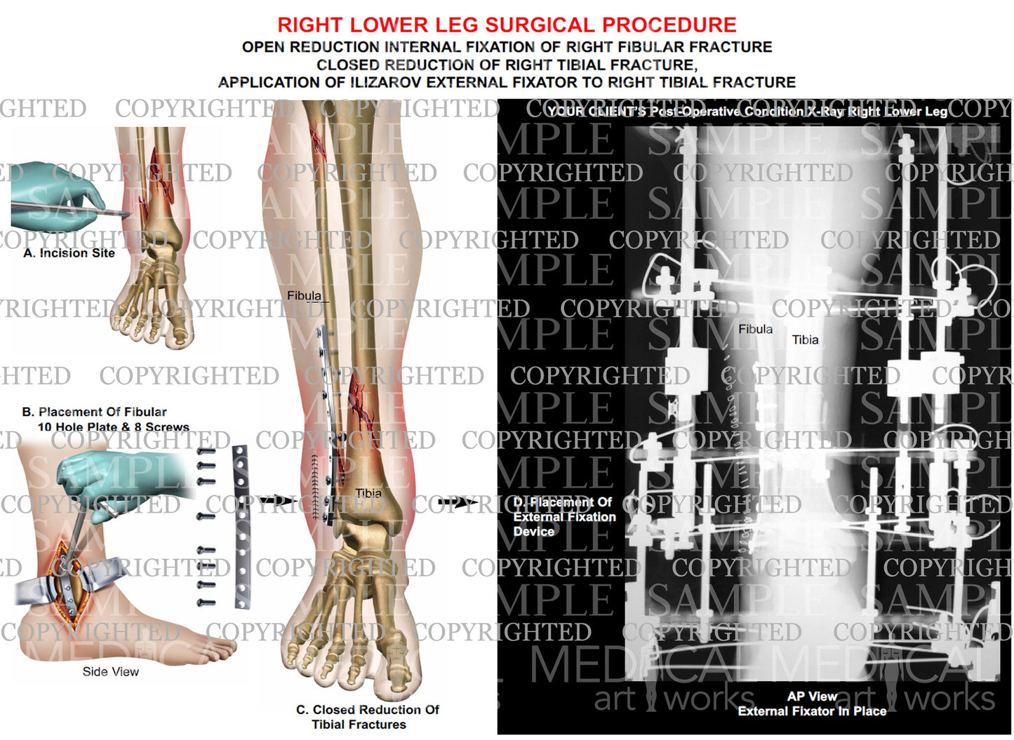 Right fibular fracture - ORIF- External fixator