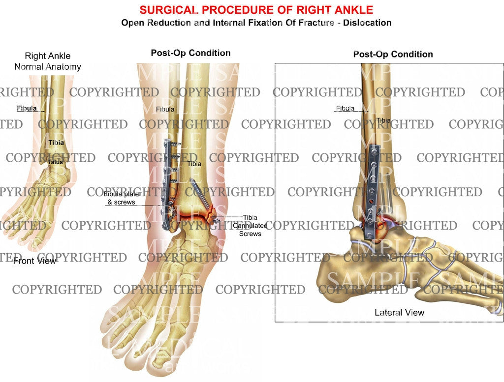 ORIF of bimalleolar tib-fib fracture