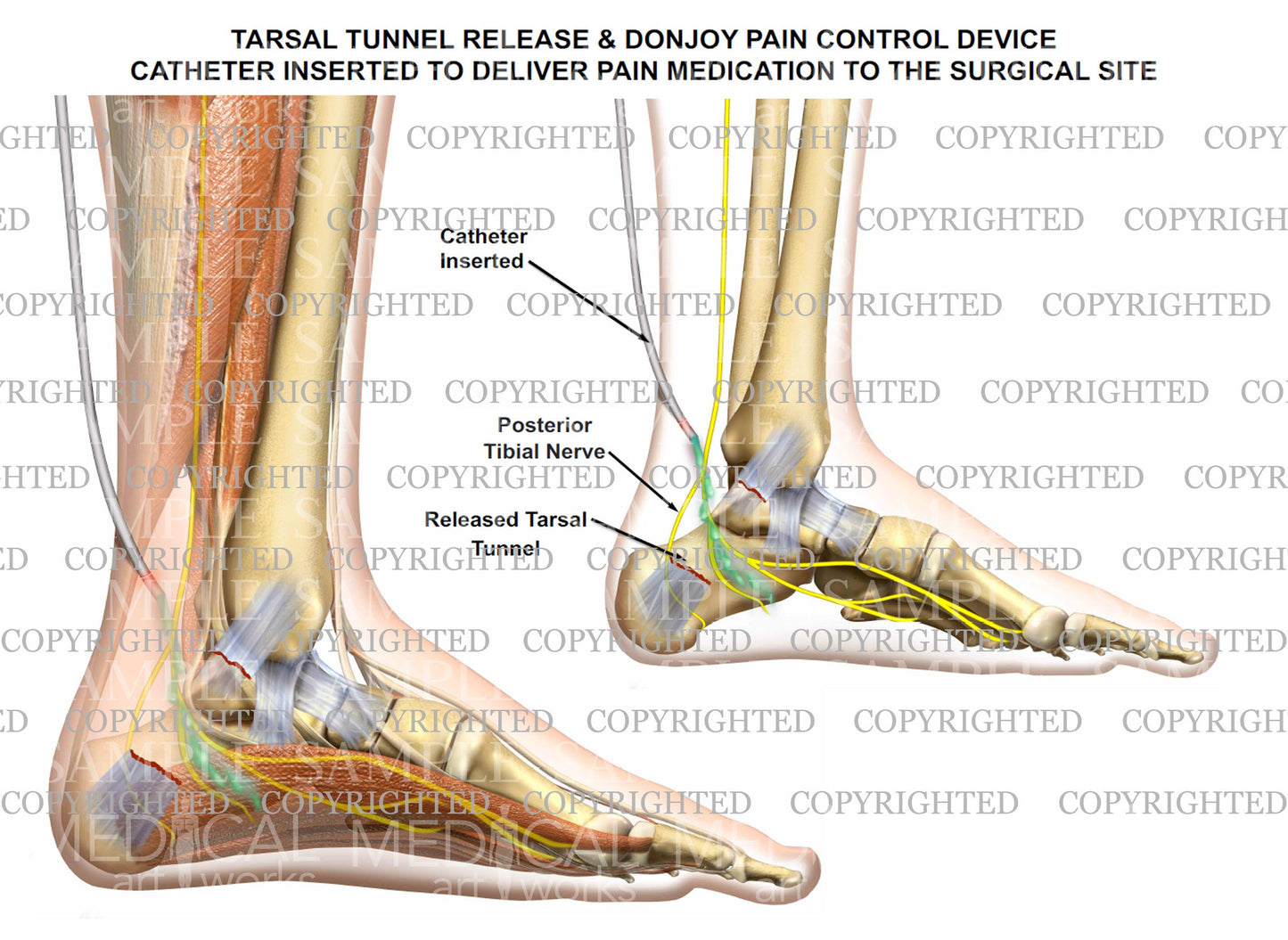 Tarsal tunnel release & Donjoy pump