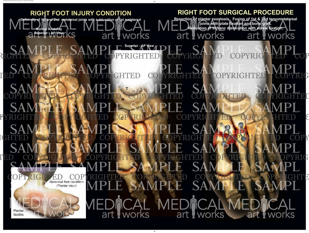 Plantar facititis, subluxation & joint fusion