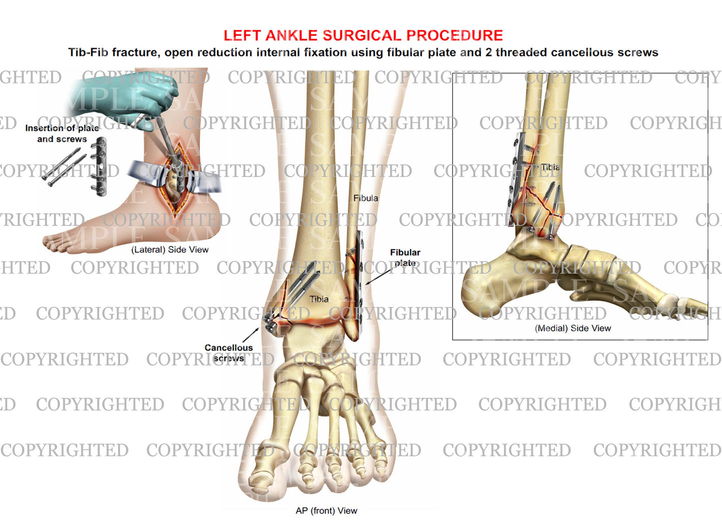 ORIF surgery of bimalleolar tib-fib fracture