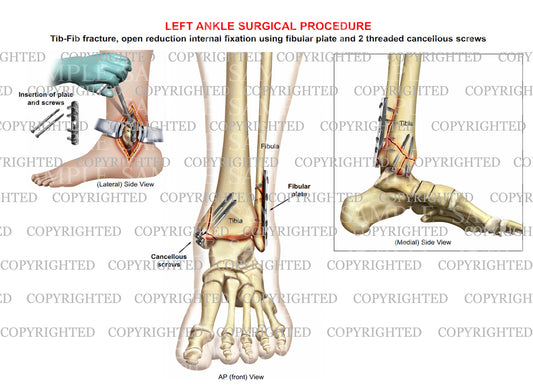 ORIF surgery of bimalleolar tib-fib fracture