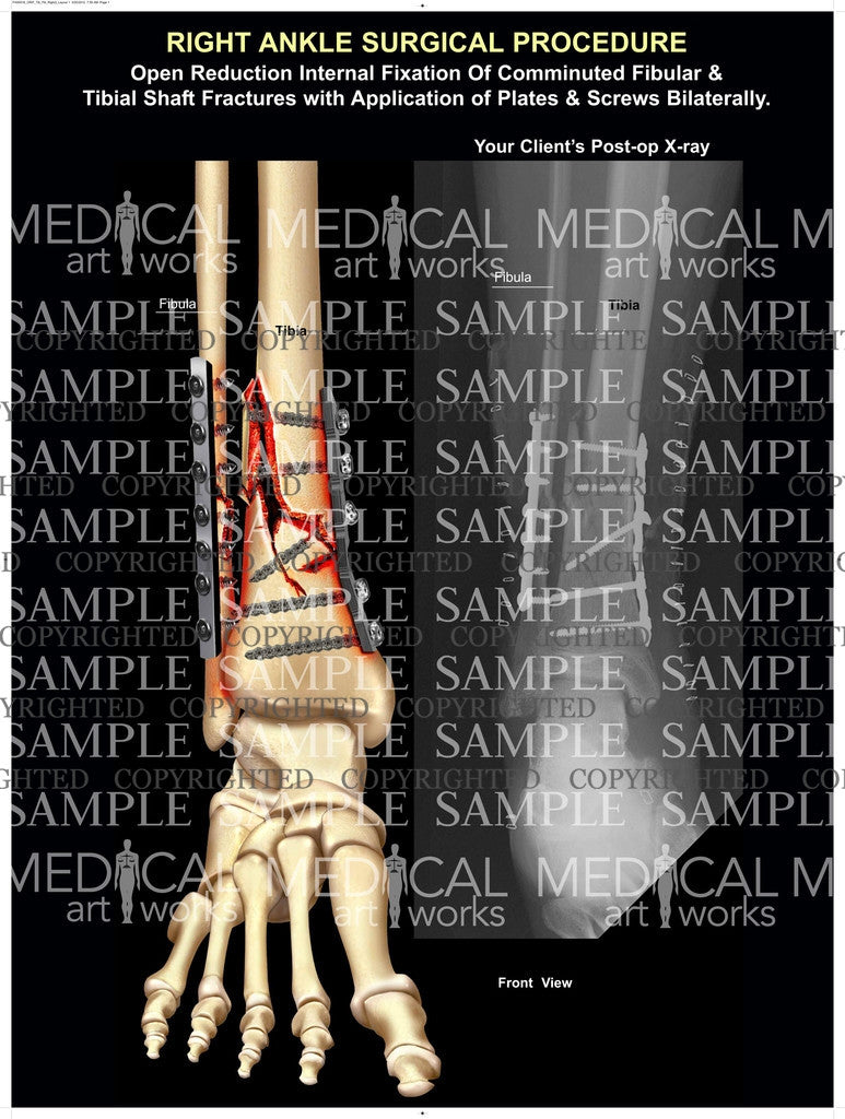 ORIF of tib-fib comminuted shaft fractures with post-op x-ray