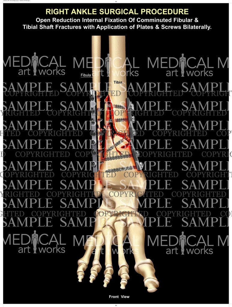 ORIF of tib-fib comminuted shaft fractures