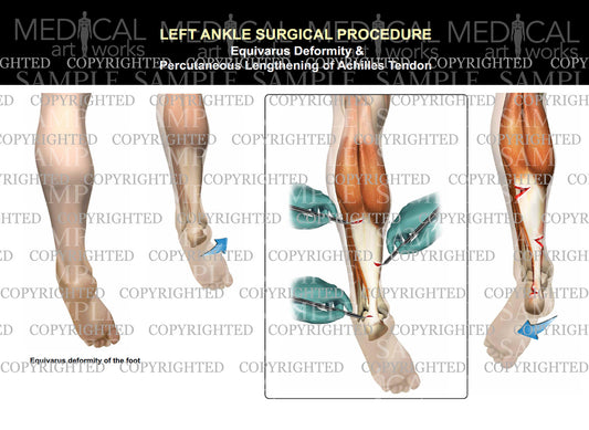 Left equivarus achilles tendon lengthening