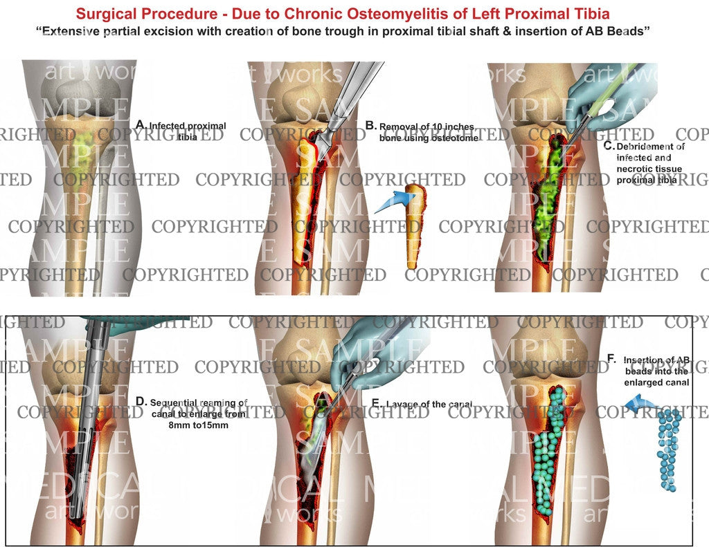 Right tibia osteomyelitis AB beads