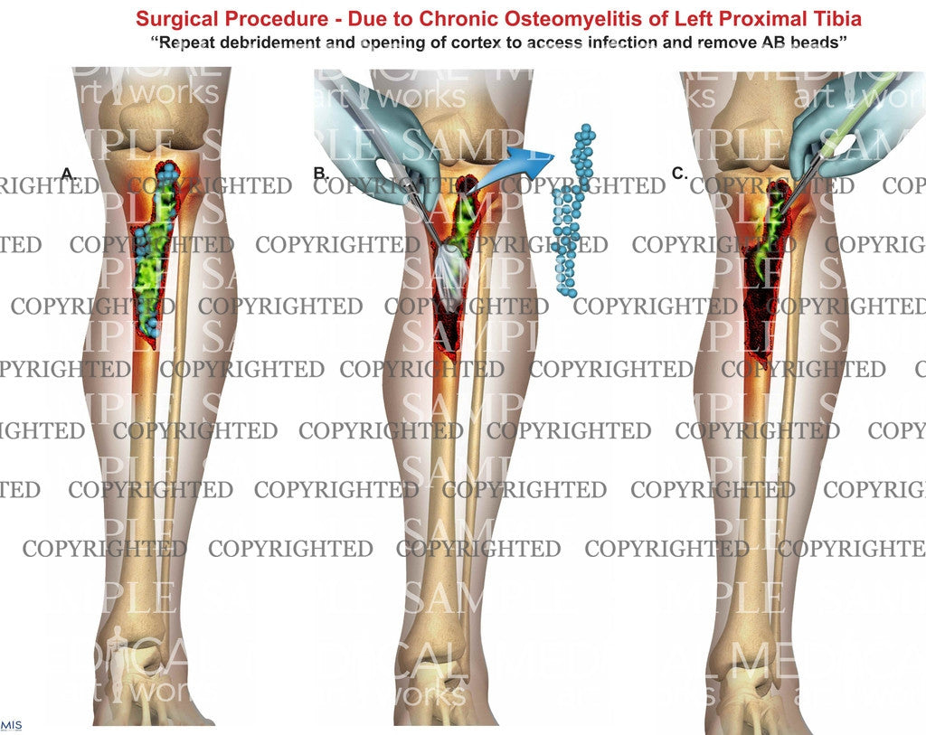 Right tibia osteomyelitis debridement