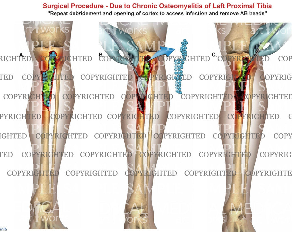 Right tibia osteomyelitis debridement