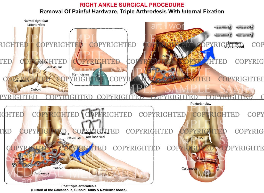 Right calcaneus hardware removal