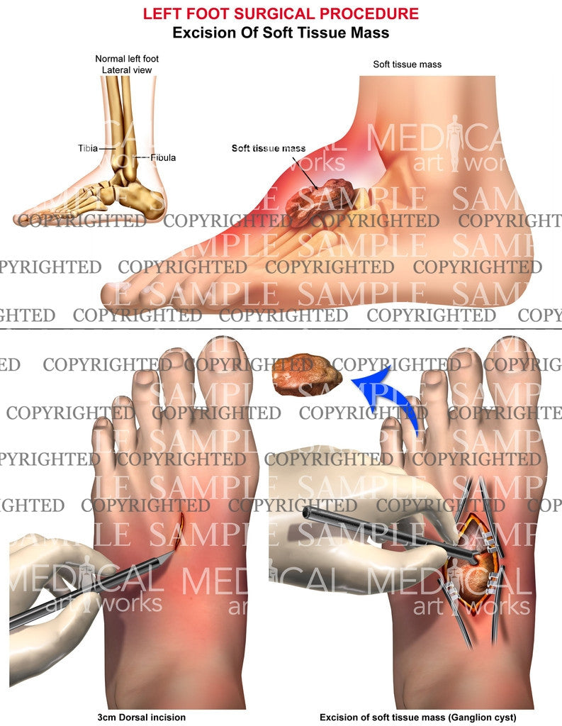 Left foot ganglion cyst excision