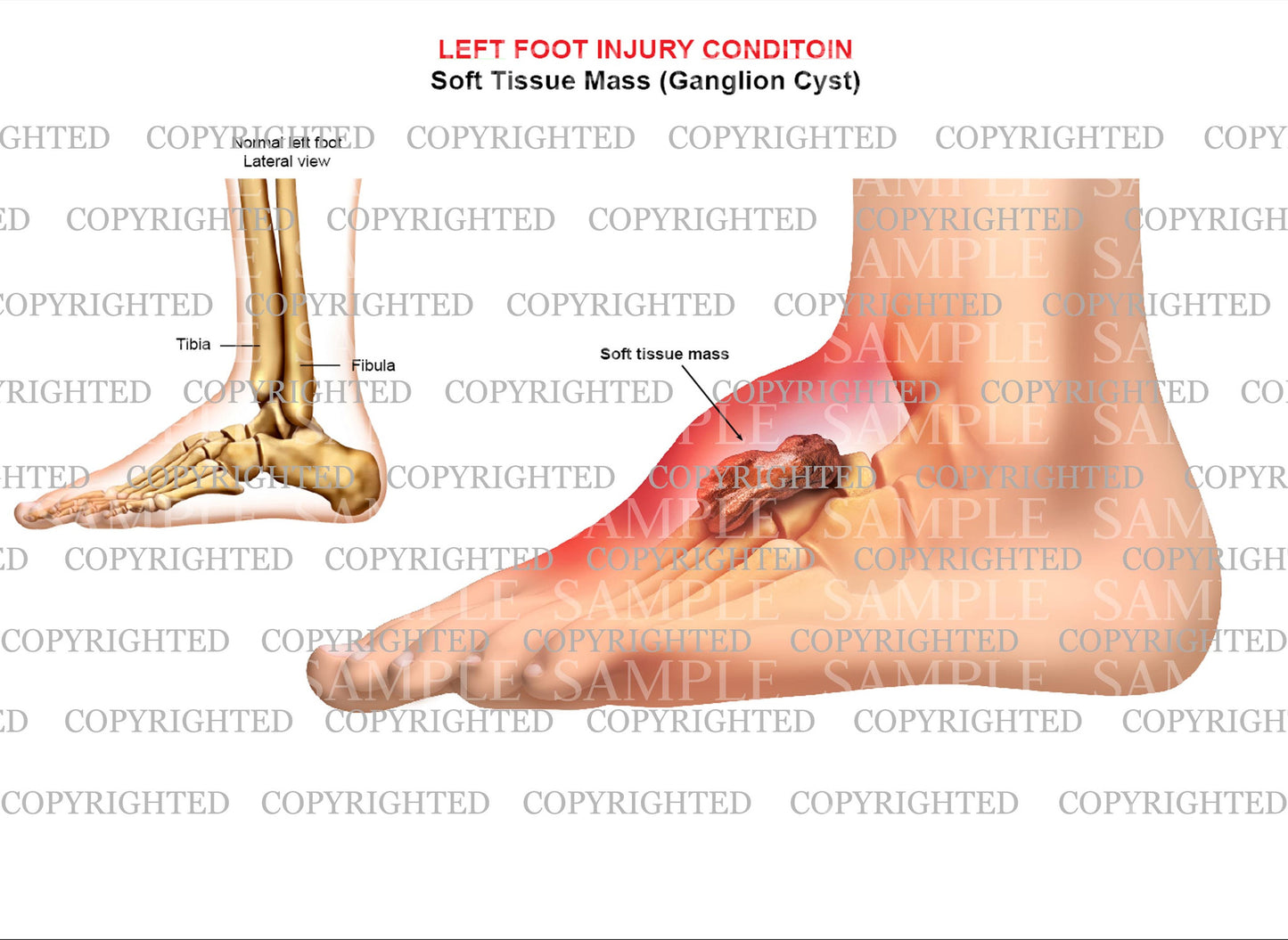 Left foot ganglion cyst