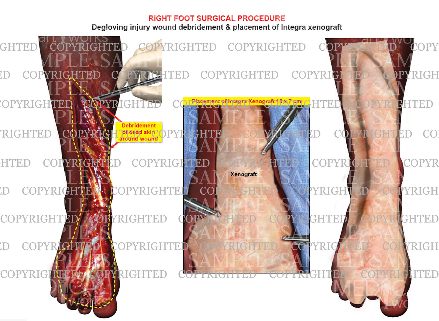 Foot wound debridement surgery and xenograft