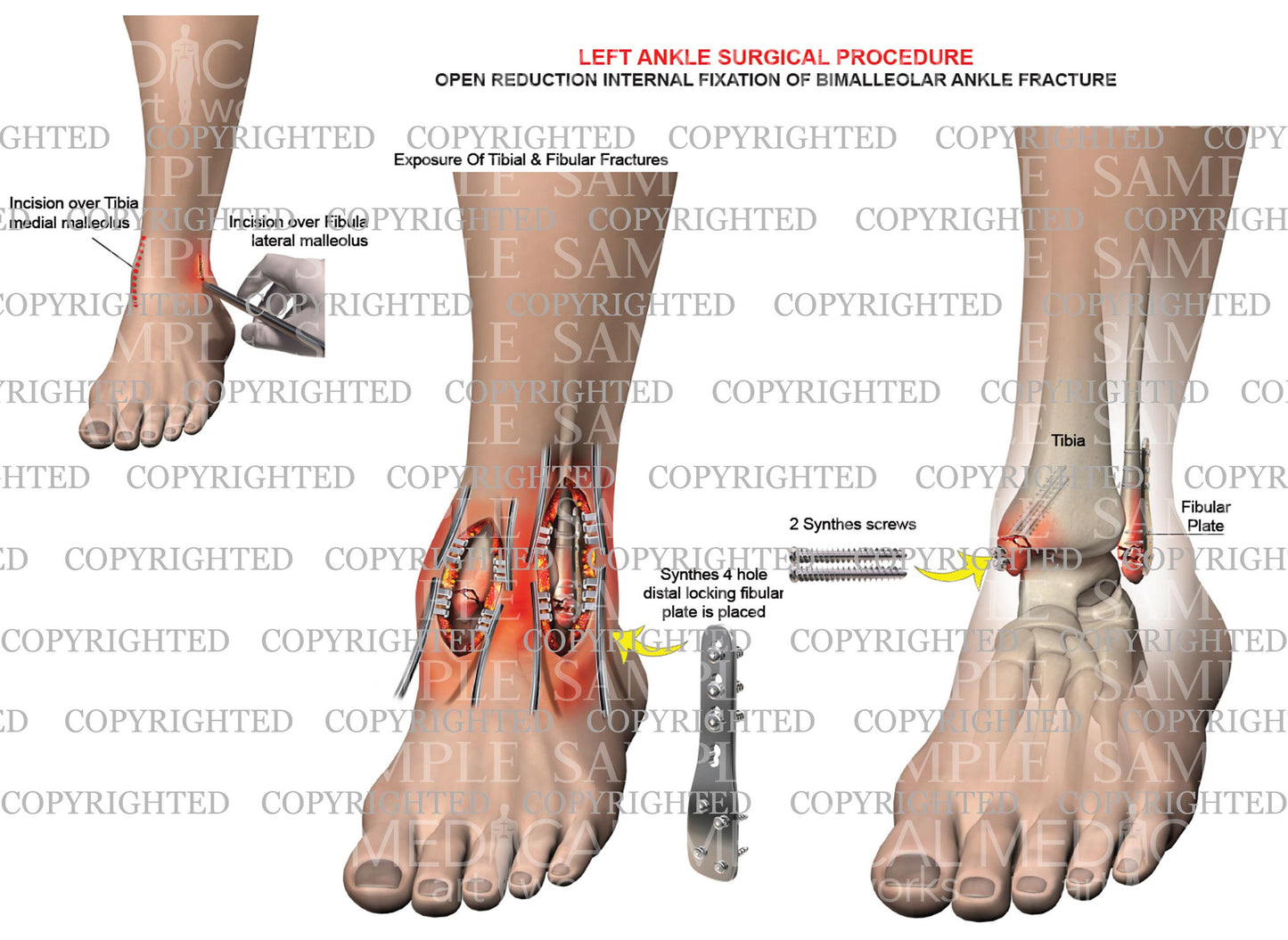 Left bimalleolar fracture and plate fixation