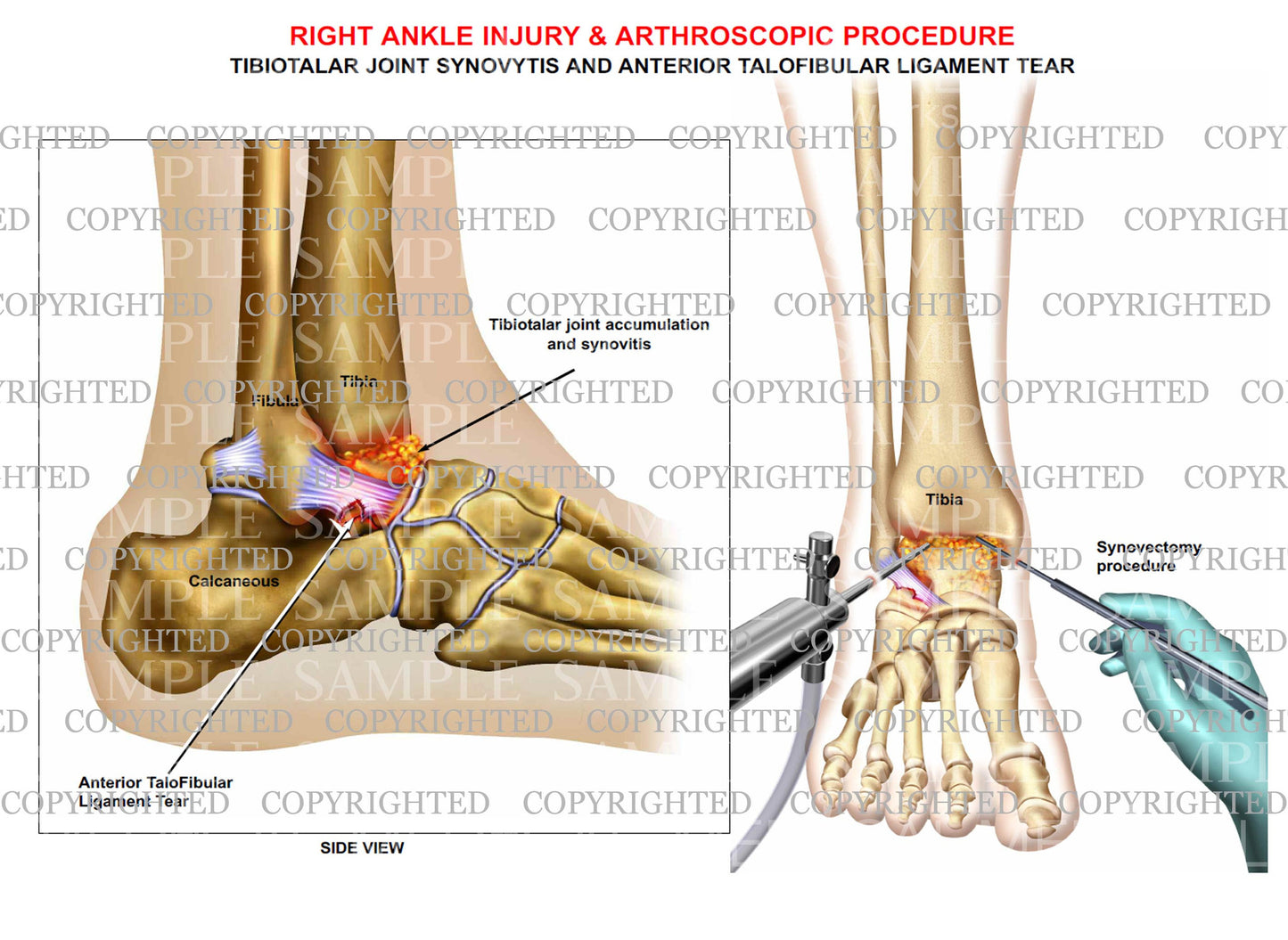 Talofibular ligament tear, joint synovitis & synovectomy