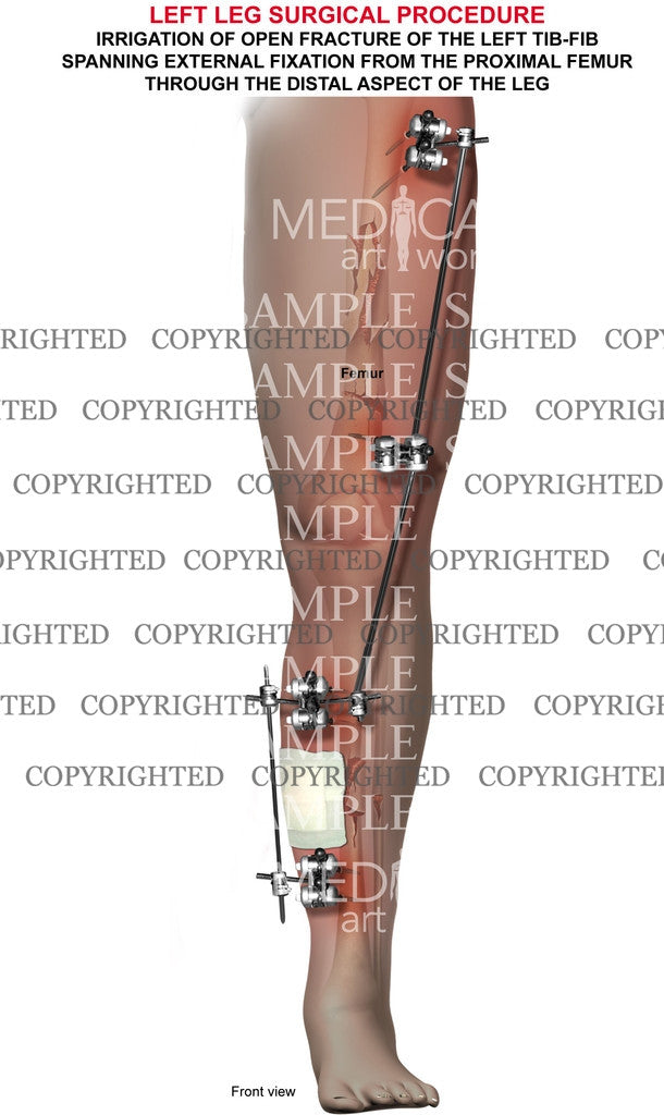 Lower extremity external fixator device