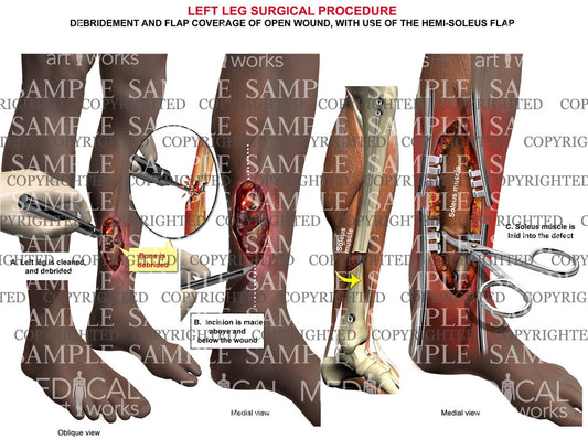Lower leg wound debridement and Hemi-Soleus flap
