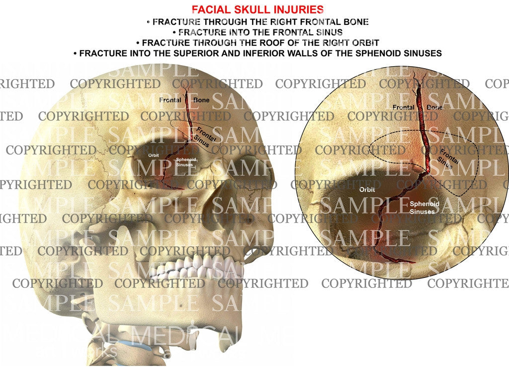 Facial skull injuries