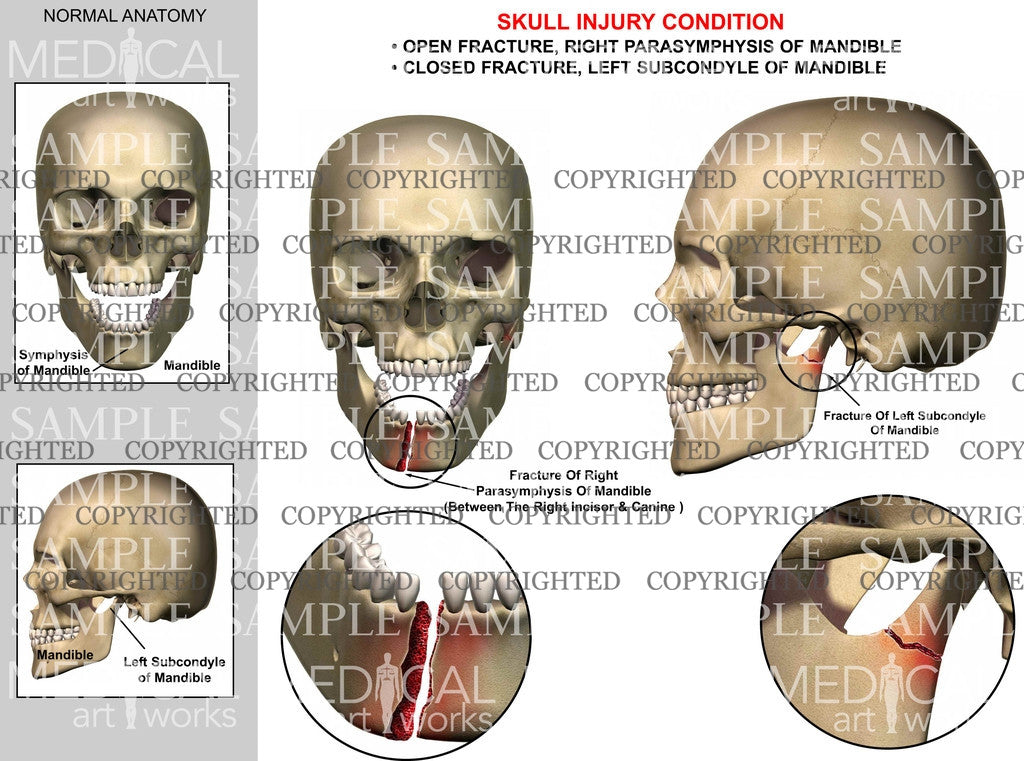 Mandibular parasymphyseal fracture