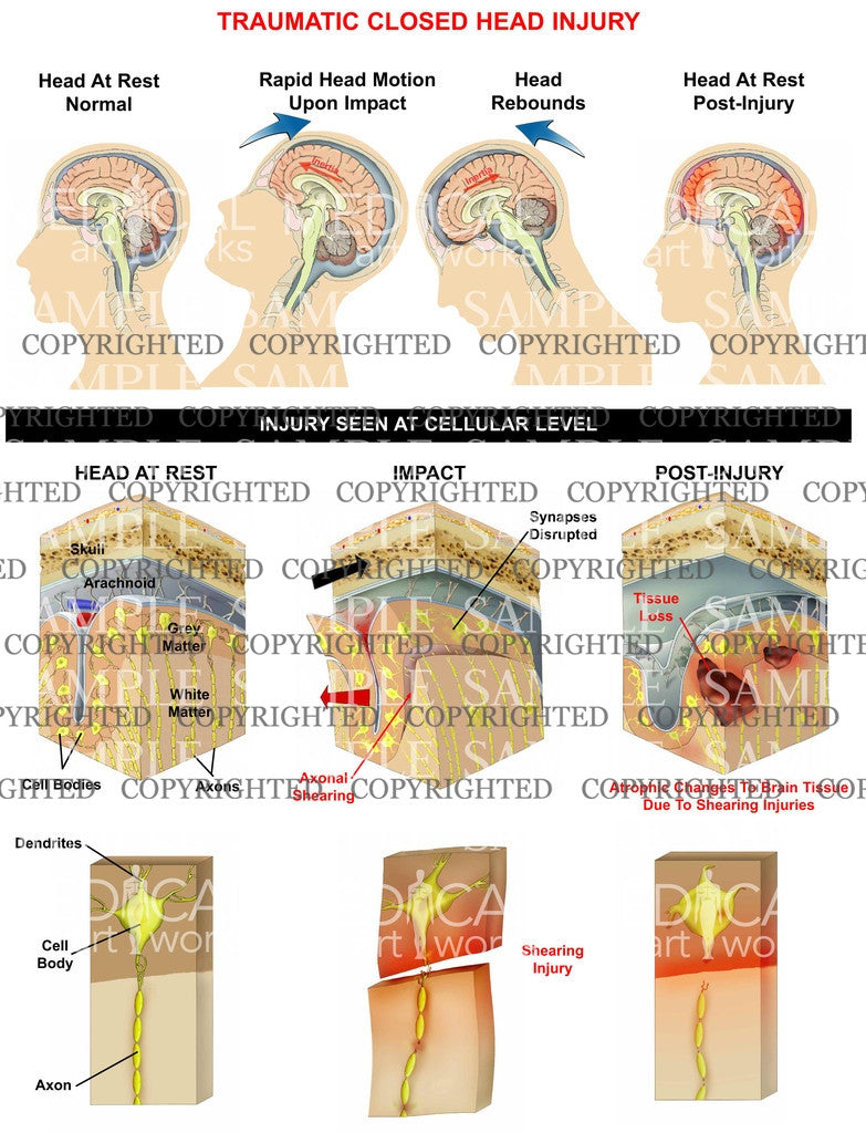 Traumatic closed head injury 2