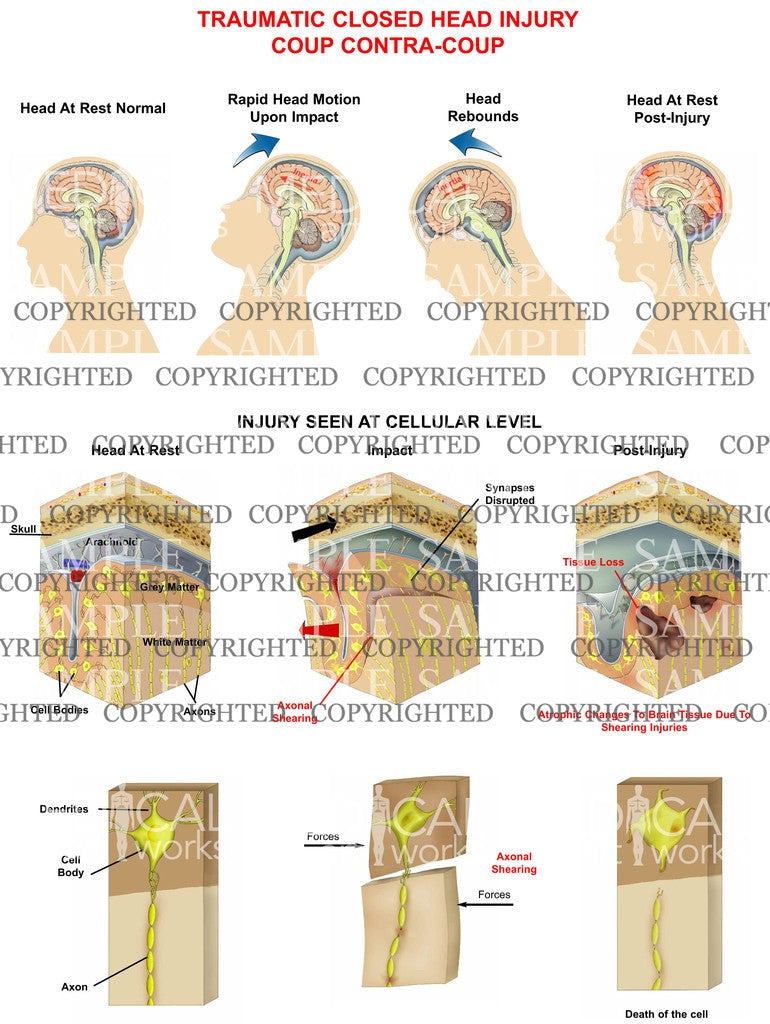 Traumatic closed head injury
